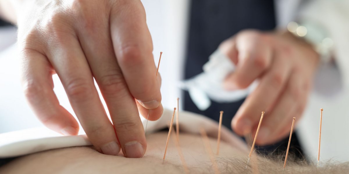 Nahaufnahme einer Hand, die Akupunkturnadeln in den Rücken eines Patienten einsticht.