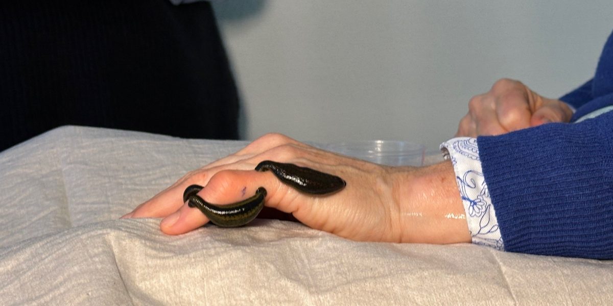 Zwei Blutegel auf einer Hand während einer Therapie, auf weißen Stoff gelegt.